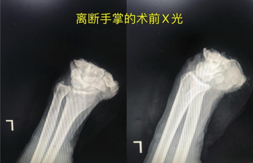 痛！一饭堂厨师砍猪脚时竟砍断了自己的手