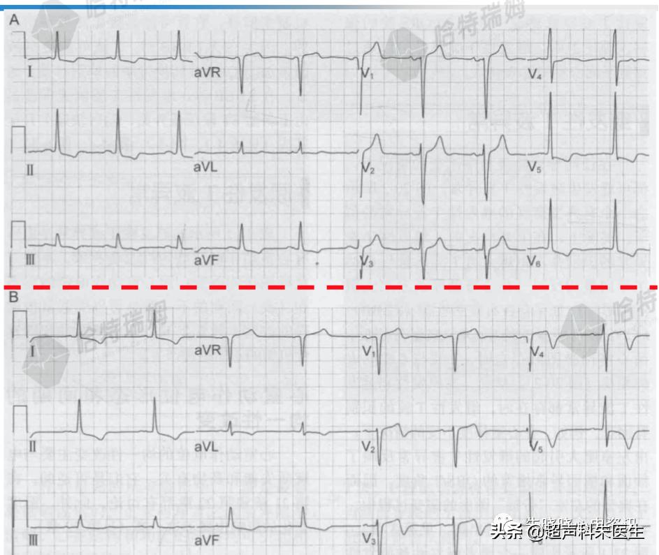 t波倒置9个真相图解,t波倒置判断口诀