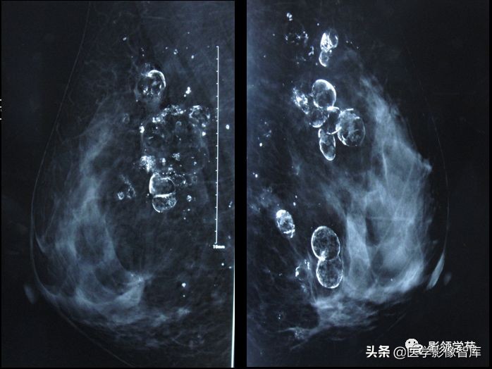 乳腺钙化怎么区分良性和恶性,乳腺钙化的诊断与分级