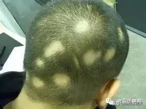 斑秃儿童饮食,饮食油腻会导致斑秃吗