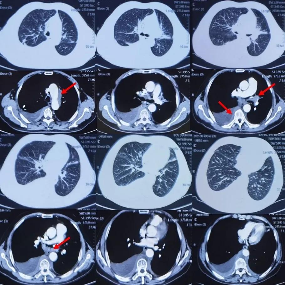 咳嗽咳痰胸腔积液10月余治疗无效，艰难追踪得出哪些教训？（上）