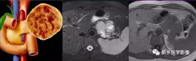 18种胰腺肿瘤，为什么我就知道两种