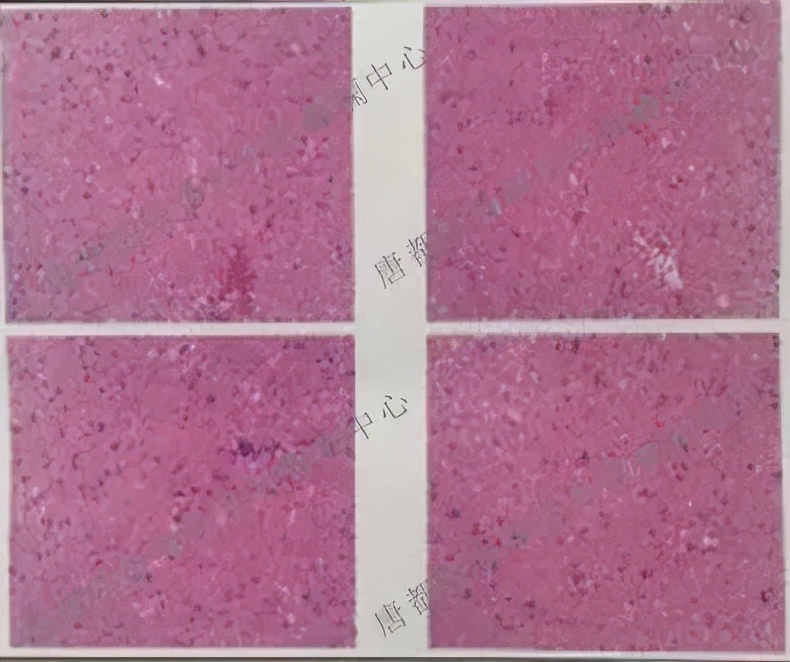 唐都医院癫痫手术能不能根治癫痫,唐都医院神经外科癫痫