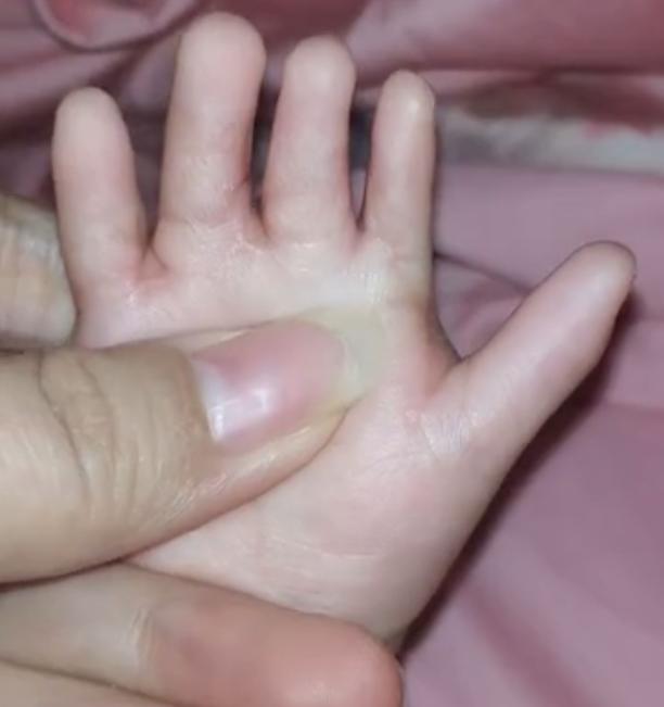 并指畸形免植皮案例,并指畸形