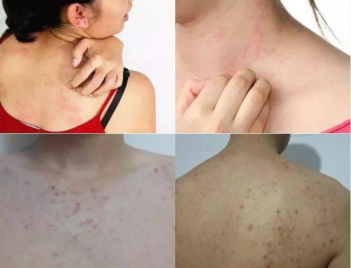 身上的螨虫会粘在衣服上吗,身上螨虫太多身体会烂么