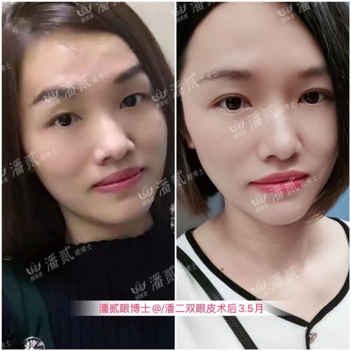 割了开扇双眼皮眼尾上扬太宽,眼尾上扬的眼睛适合什么双眼皮