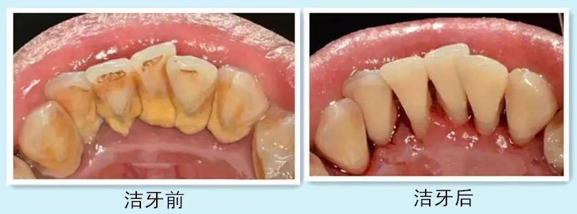 保定这个地儿，9.9元做超声波洁牙！还不去给你的牙齿洗个澡吗？