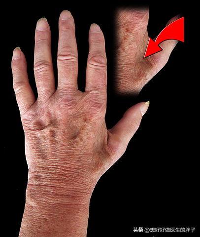 胳膊用力过度后胳膊肘疼怎么回事,胳膊肘劳累过度关节疼痛用什么药