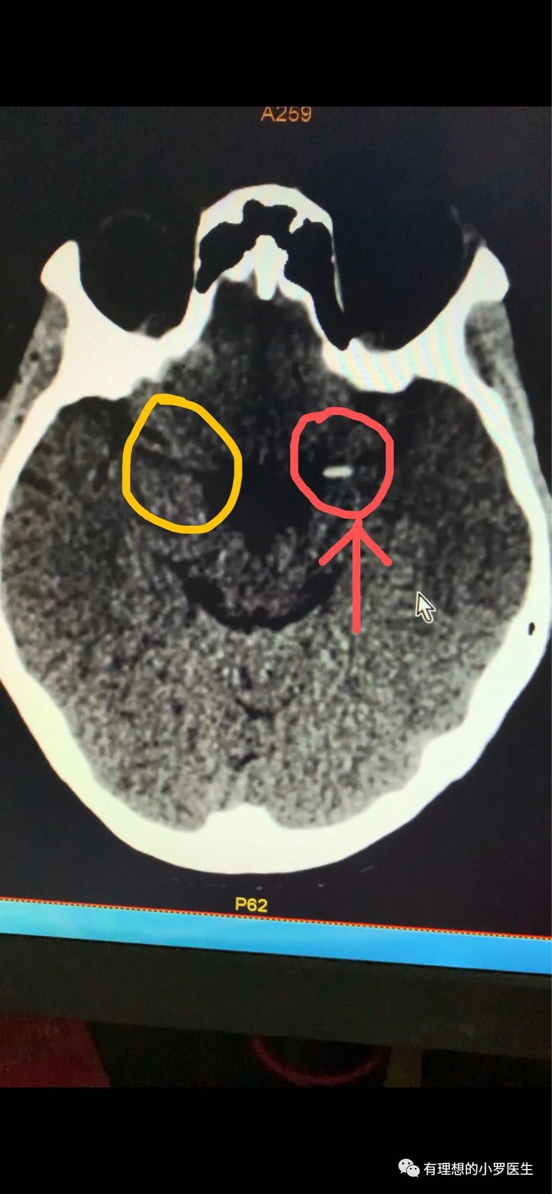 停药的后果,停药后的痛苦事件