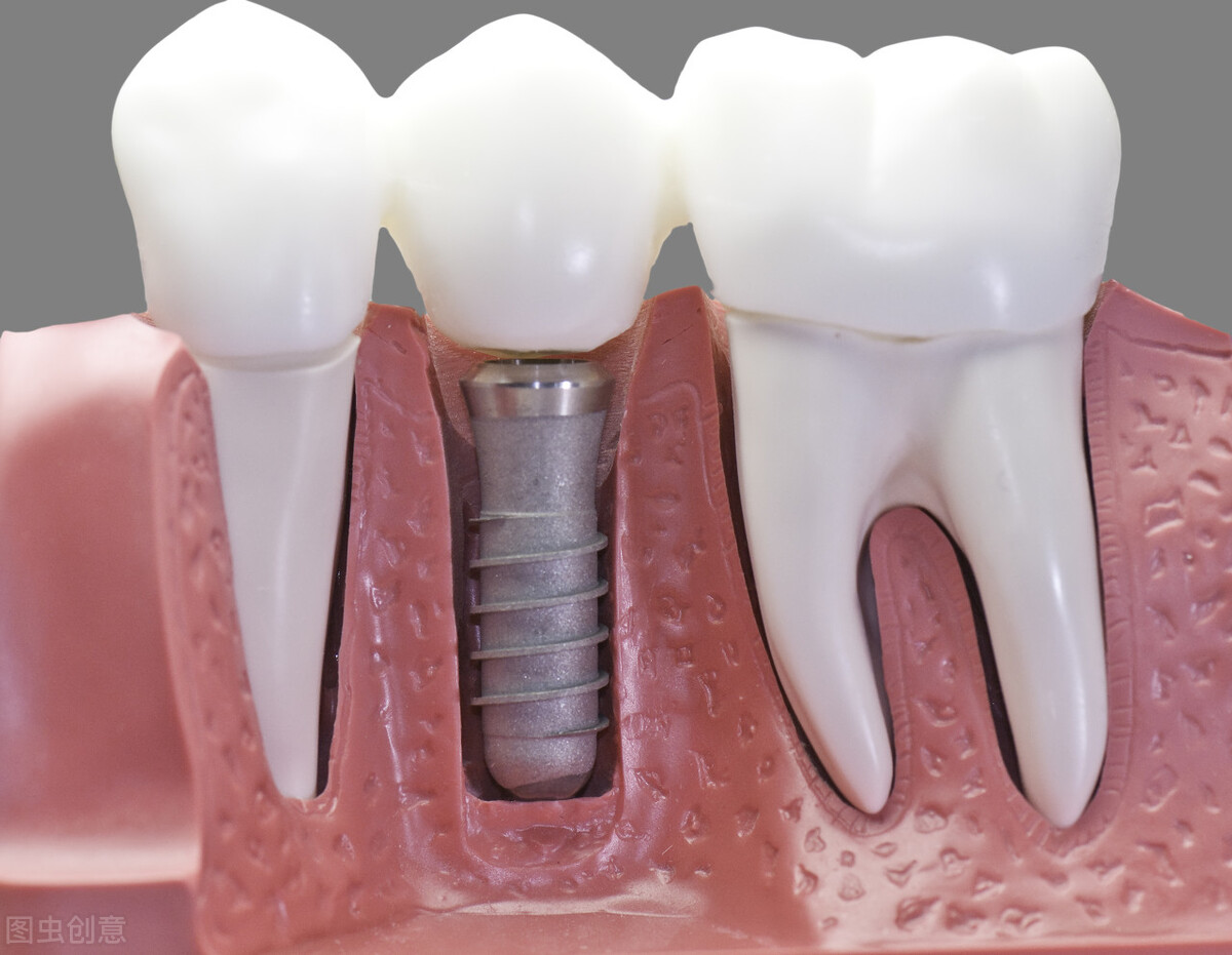 种植牙齿需要多少钱全过程,种植牙齿的全过程需要多少钱