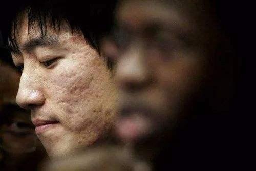 脸上留下的痘坑怎么治,脸上坑坑洼洼痘坑怎么修复