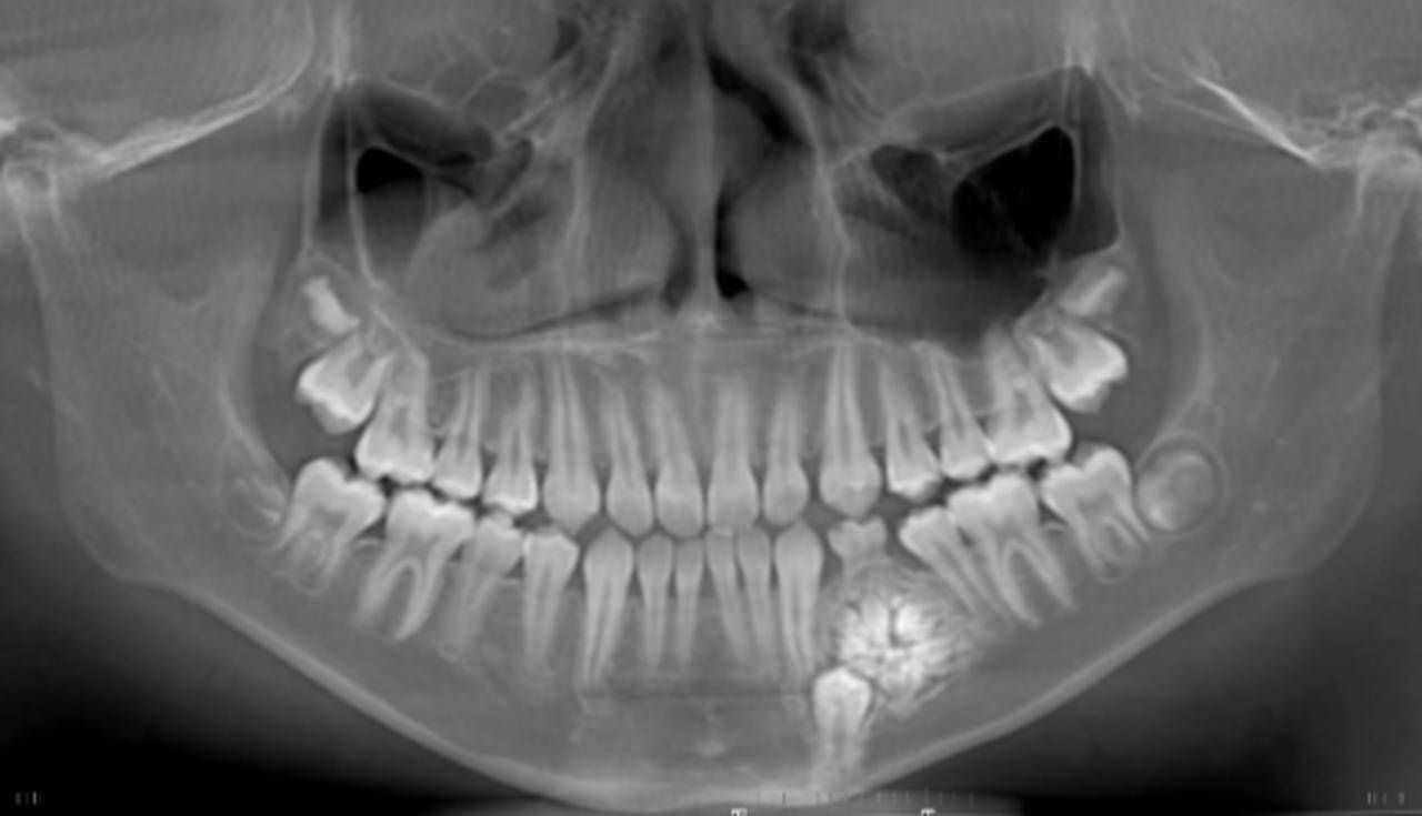 11岁男孩肿瘤手术后续,12岁男孩牙瘤手术后遗症