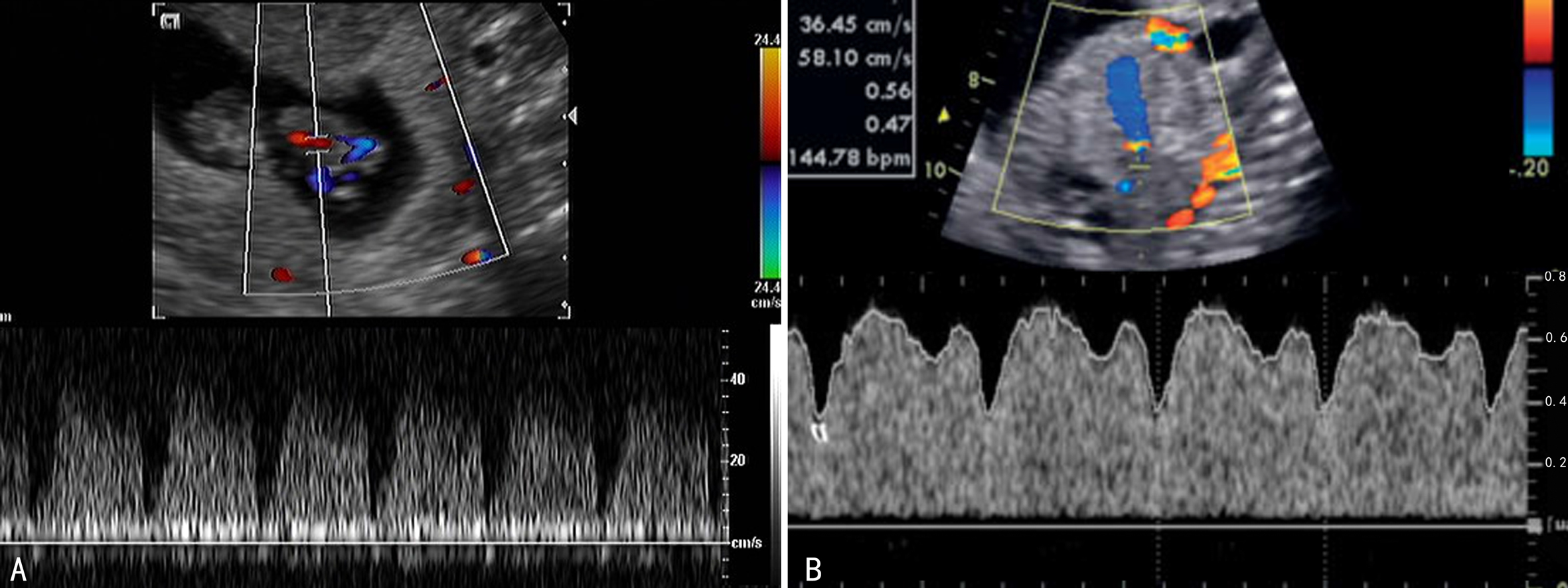 做彩超显示胎儿内脏在右边正常吗,胎儿系统性彩色多普勒超声筛查