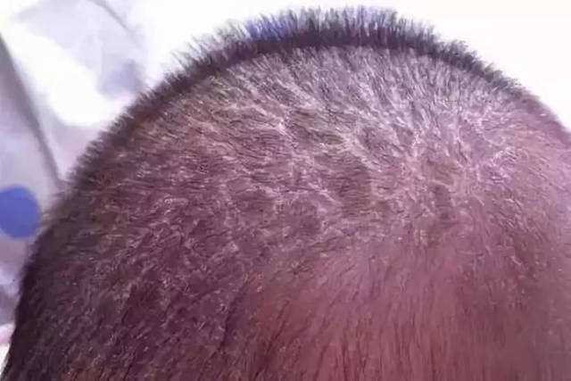 孕期吃鹅蛋真的去胎毒了吗？可能会让你长胖，但去不了“胎毒”