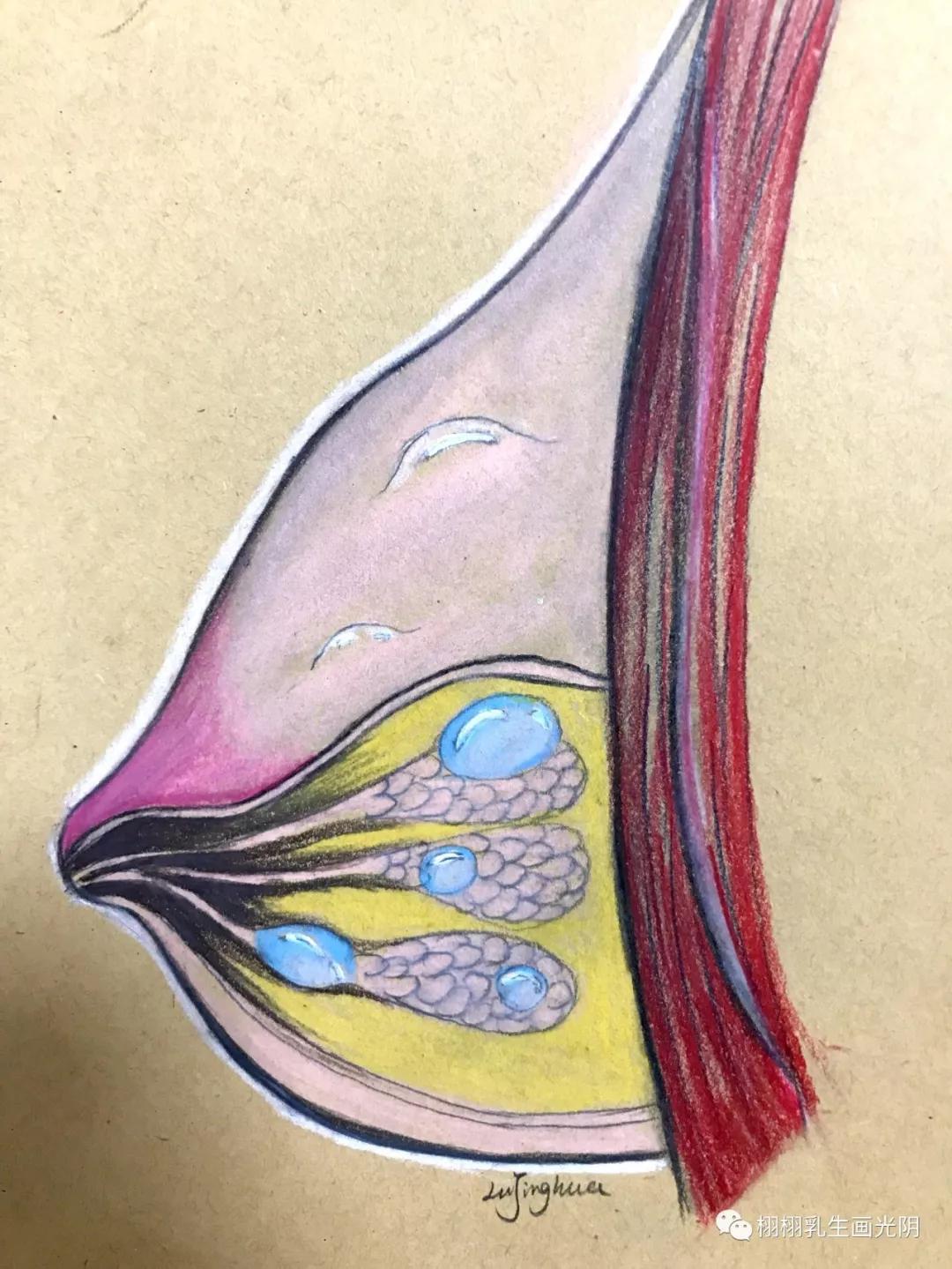 乳腺囊肿为什么会得这个病,乳腺囊肿的科普