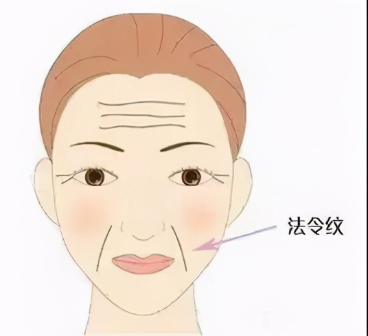 法令纹什么医美手段可以解决,法令纹严重怎么办30岁