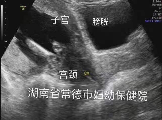 孕妇尿潴留怎么治疗才能断根,孕妇非梗阻性尿潴留