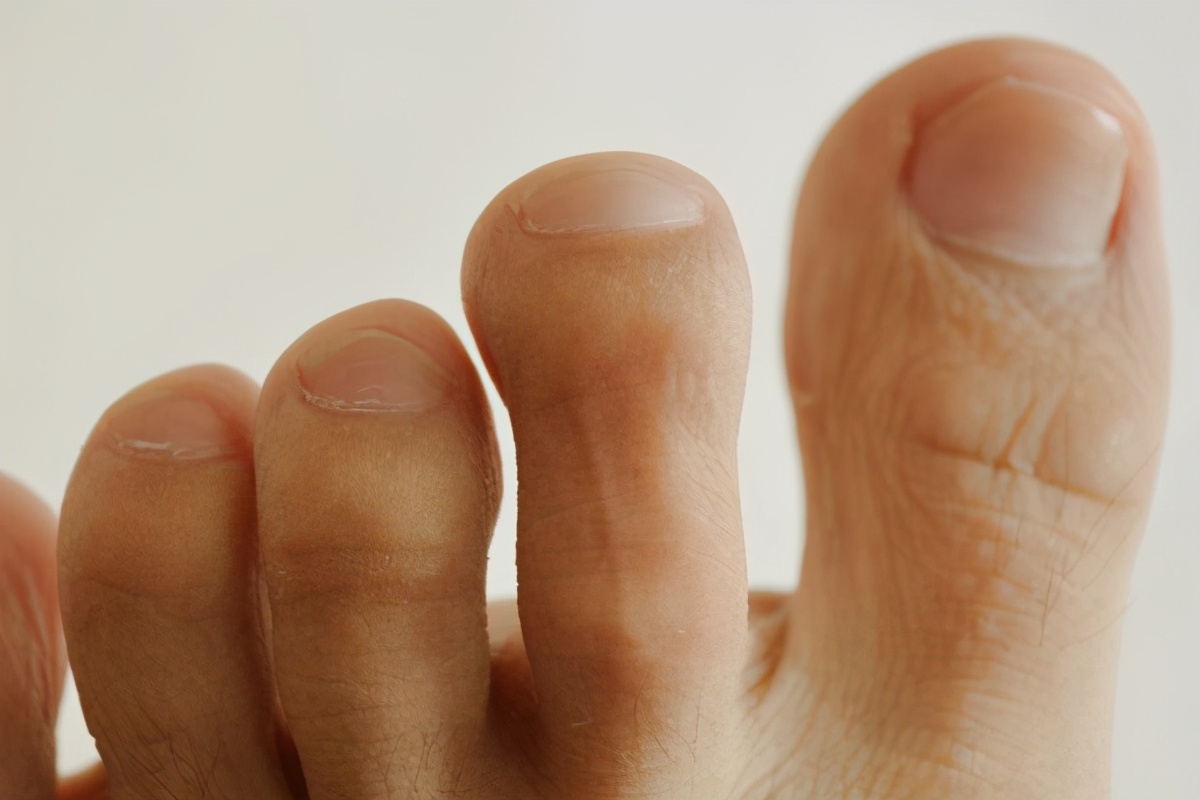 甲沟炎断甲嵌在肉里怎么办,为什么甲沟炎脚趾肉会是硬块