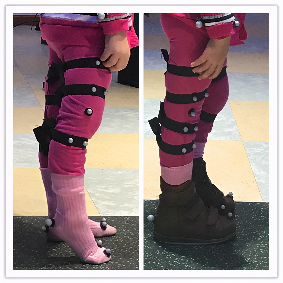 定制矫正鞋鞋垫,定做矫正鞋的地方在哪里