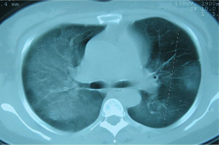 养鸽子造成皮肤真菌感染,养鸽子会得肺炎吗