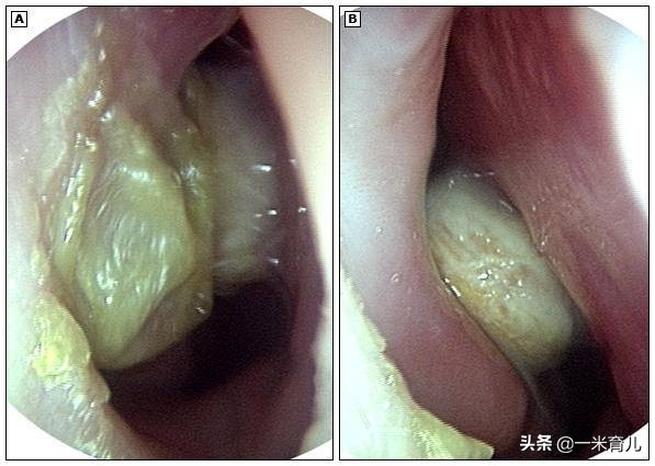5岁鼻异物,18岁仍作妖!儿童发生鼻腔异物,先来做好这4步
