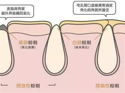 脸上的白点点怎么回事,脸上有白色脂肪粒是什么原因