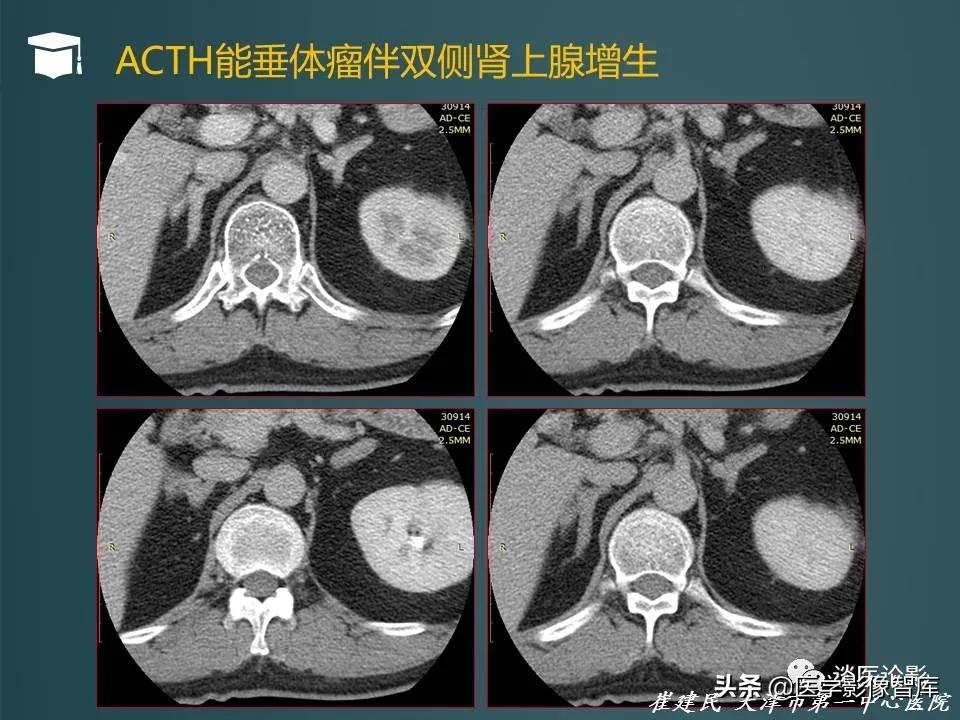 左侧肾上腺结节考虑腺瘤与增生,双侧肾上腺增生是什么原因造成的