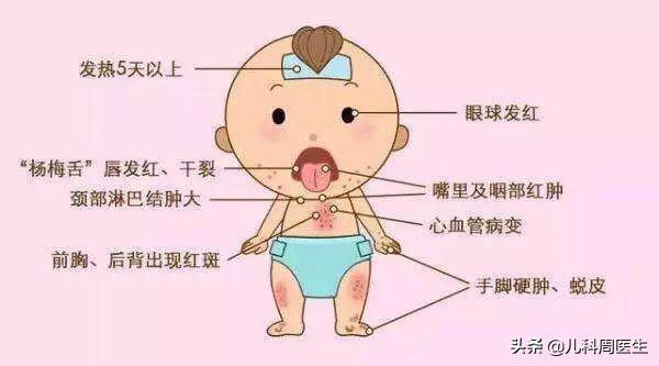 川崎病的孩子为啥容易感冒,怎样确诊儿童得了川崎病