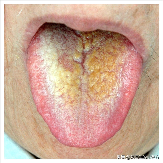 中医舌诊图解100例,中医舌诊图与舌诊口诀