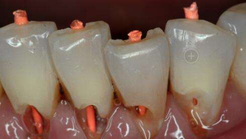 牙齿侧面有个小黑洞擦牙会酸,牙齿上有洞喝水冒凉气怎么治疗