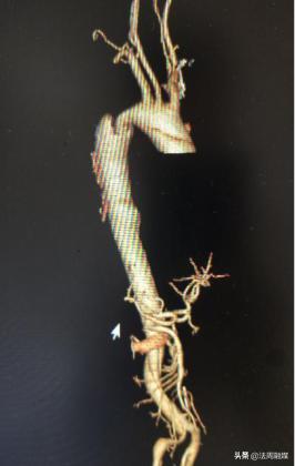 岳阳市一医院主动脉夹层手术,介入微创治疗a型主动脉夹层