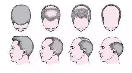 额头两边头发后移怎么治,两边额角头发向后移怎么办