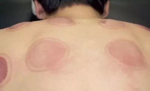 拔罐后为啥有的罐印有的深有的浅,拔罐对人是有好处还是有坏处