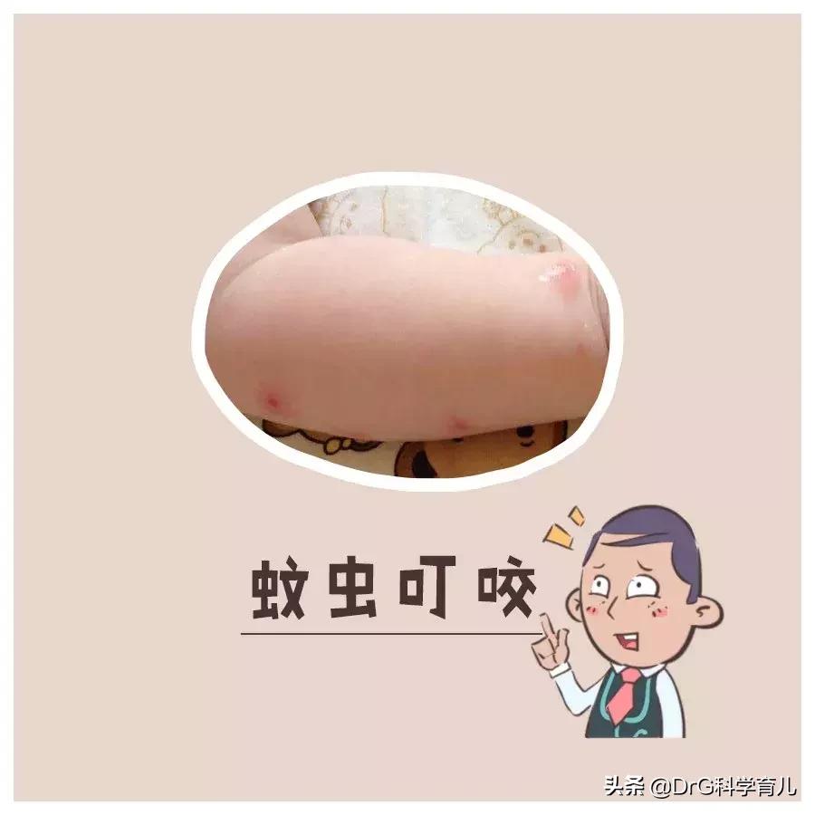 天气热了长痱子怎样快速解决,天热身上起痱子有特效药吗