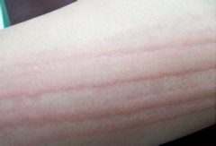 人工性*麻疹荨**是怎么造成的？很严重吗？