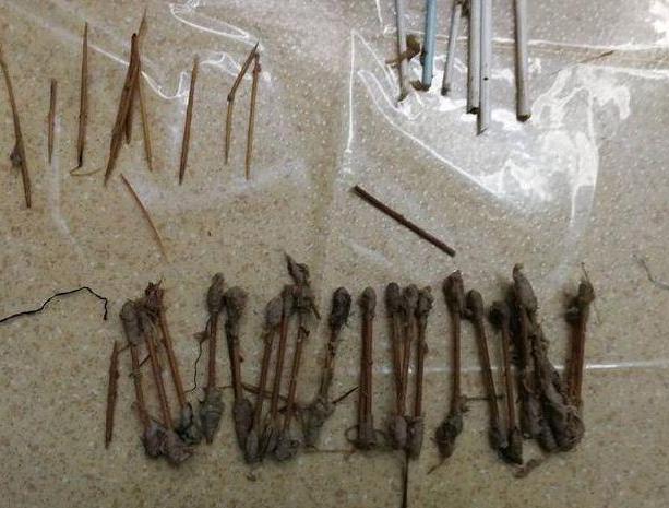 儿童小肠切除5厘米,小孩子小肠切除70公分严重吗