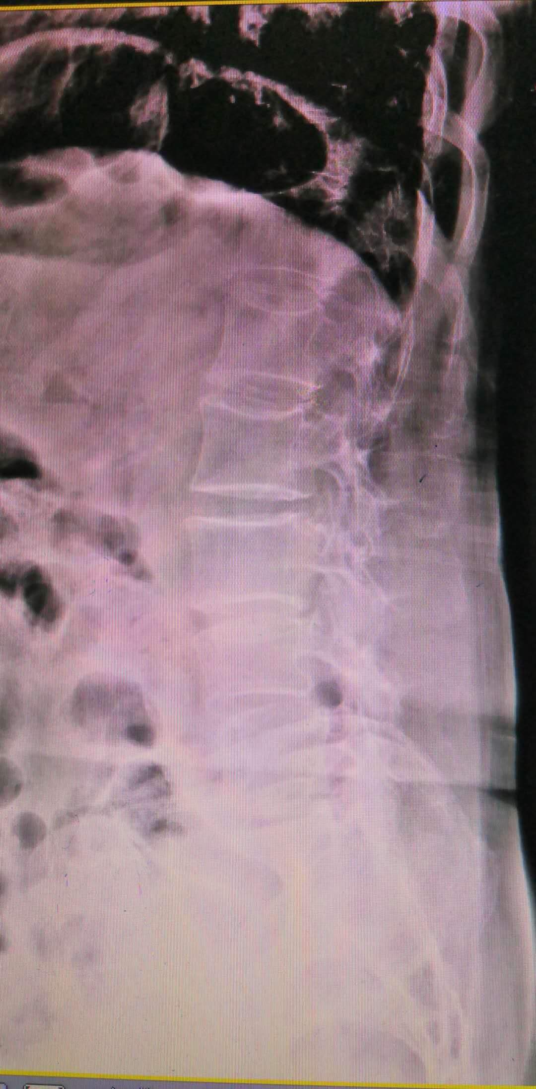 腰椎滑脱最终都要做手术么,为什么腰椎滑脱不建议手术