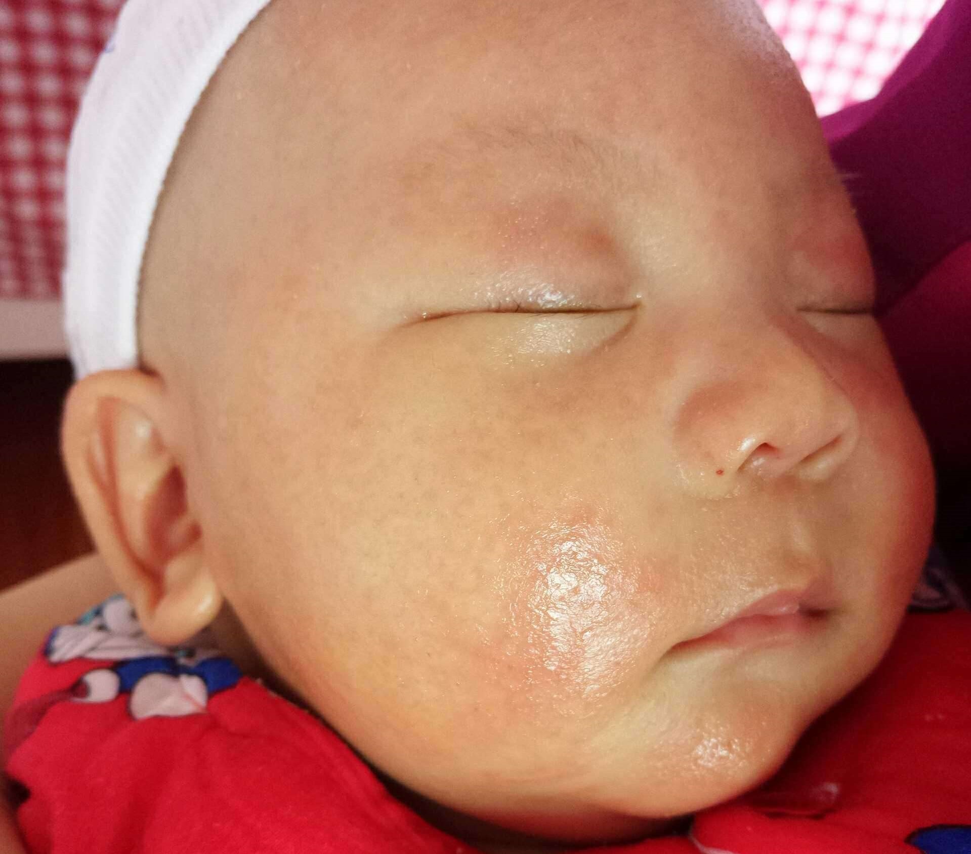 宝宝湿疹反复发作怎么办,宝宝湿疹反复该怎么护理