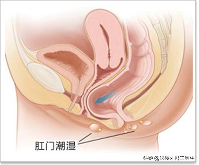 肛门潮湿瘙痒是湿热症状吗,肛门潮湿瘙痒还有味怎么治疗
