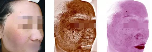 氨甲环酸对褐青斑有效果吗 (氨甲环酸去褐青斑吗)