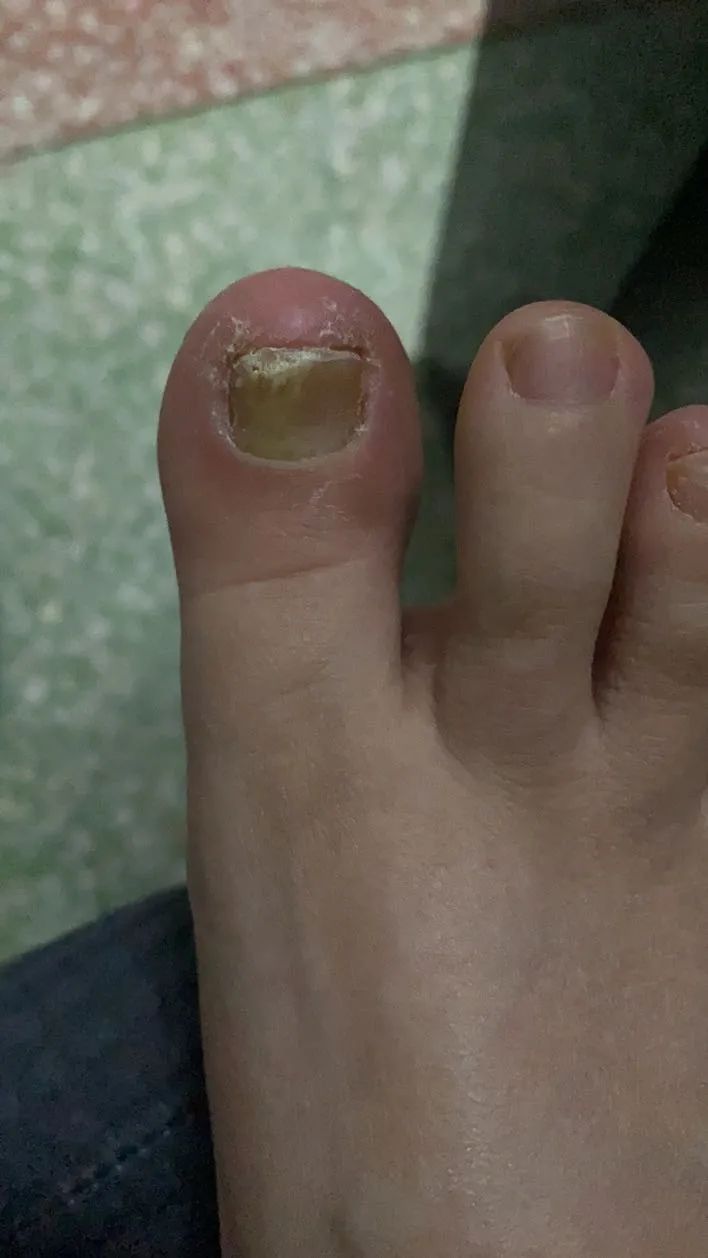 及时治疗脚气,是对家人最好的负责