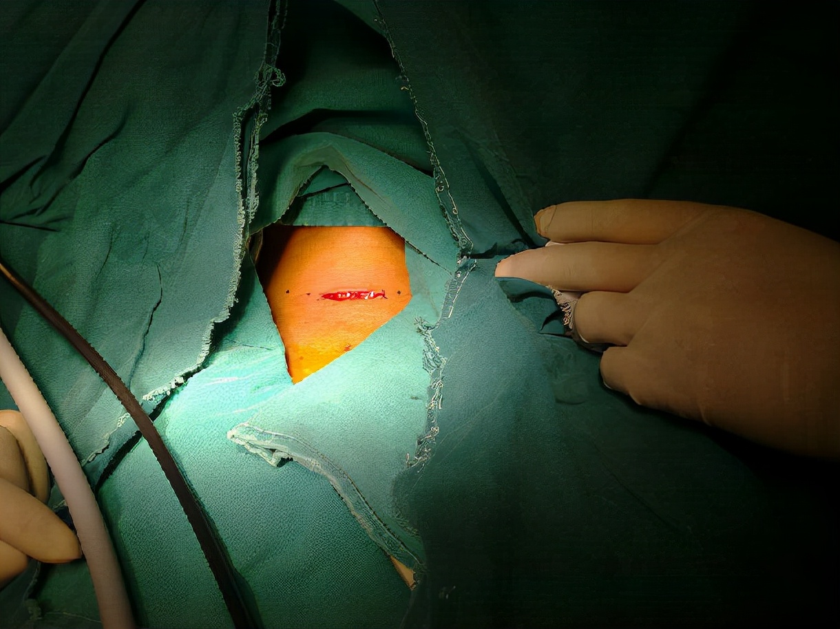 甲亢治愈的真实例子,甲亢用药过量导致甲减脖子粗