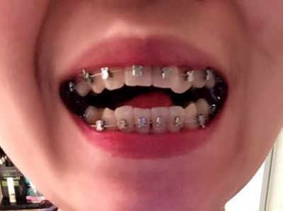 牙齿矫正为啥后期就不怎么痛了,牙齿矫正痛不痛