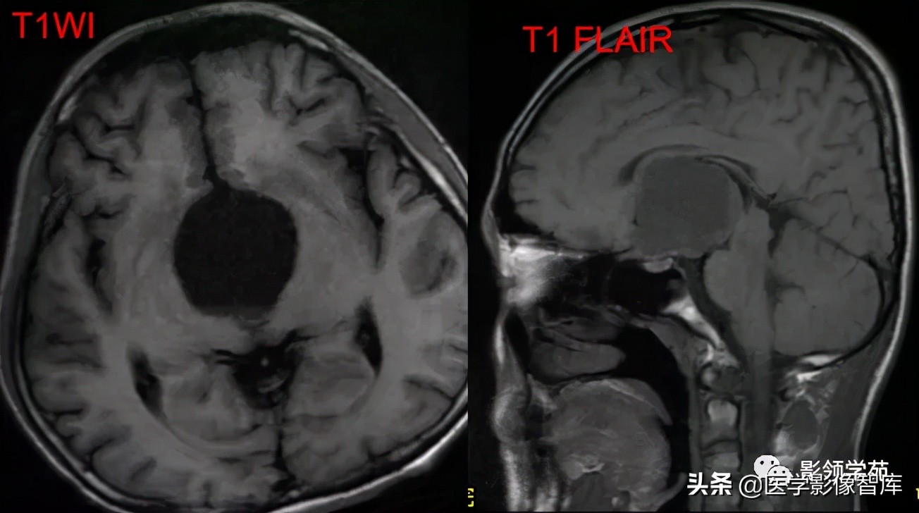 鞍区肿瘤做什么检查得出来,鞍区肿瘤的影像学鉴别
