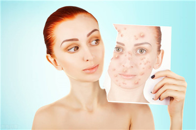 痘痘很严重可以涂什么乳,痘痘严重喝中药有效吗