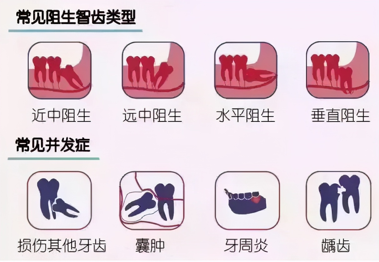 智齿到底要不要拔掉专家告诉你,有什么办法治疗智齿