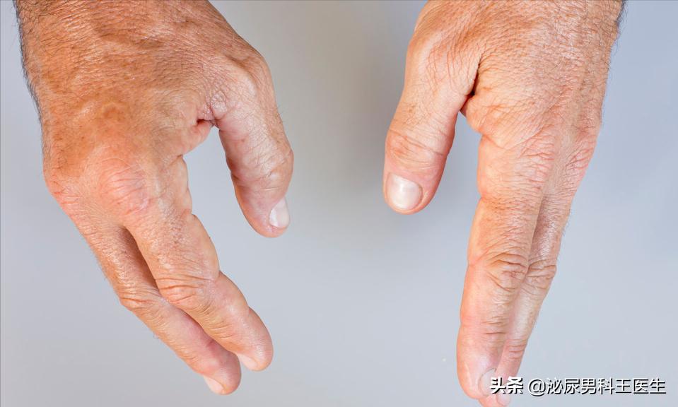 尿酸高身体会出现哪些症状,尿酸高怎么调理下来还需要吃药