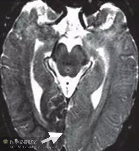 儿童癫痫CT表现,儿童各类癫痫脑电图特征