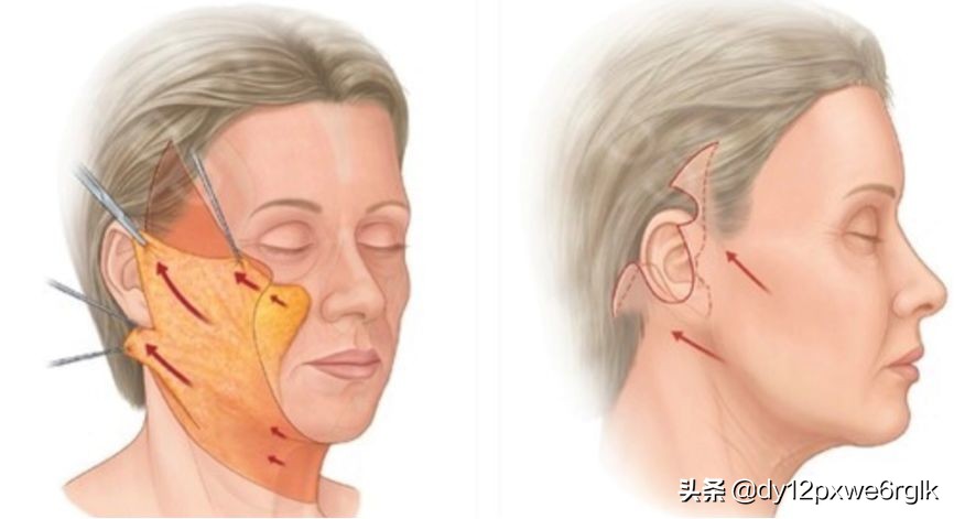 拉皮术除皱是怎么做的,拉皮除皱术怎么样有啥副作用吗