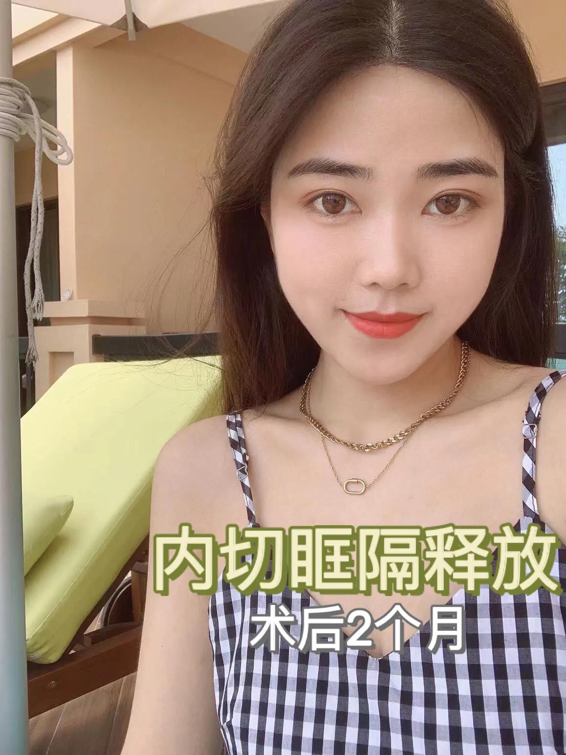 祛眼袋加眶隔释放要多久才恢复,眶隔释放眼袋术没做好怎么修复